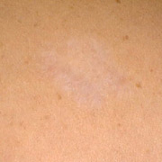 Tattoo Removal Du Bois Pennsylvania